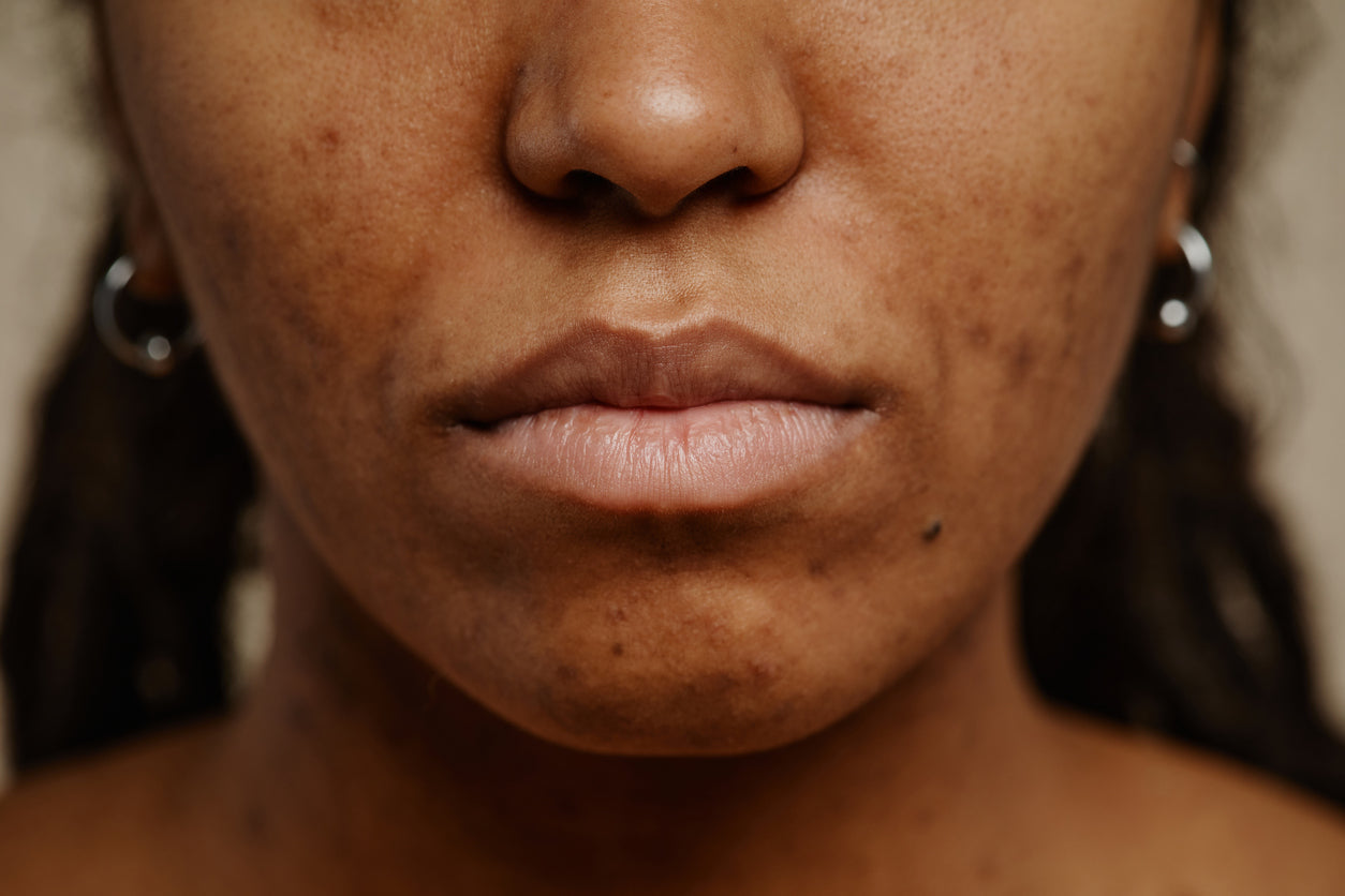 Partie inférieure d'un visage de femme noire avec marques d'acné