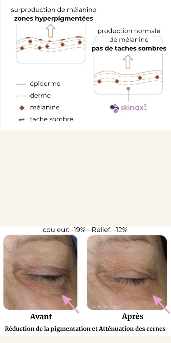 photo montrant l'efficacité du skinax2 : en haut schema montrant l'effet sur les taches sombres, en bas photos avant/après d'une cerne