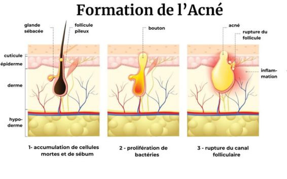 schéma vue en coupe de la peau expliquant le processus de formation de l'acné