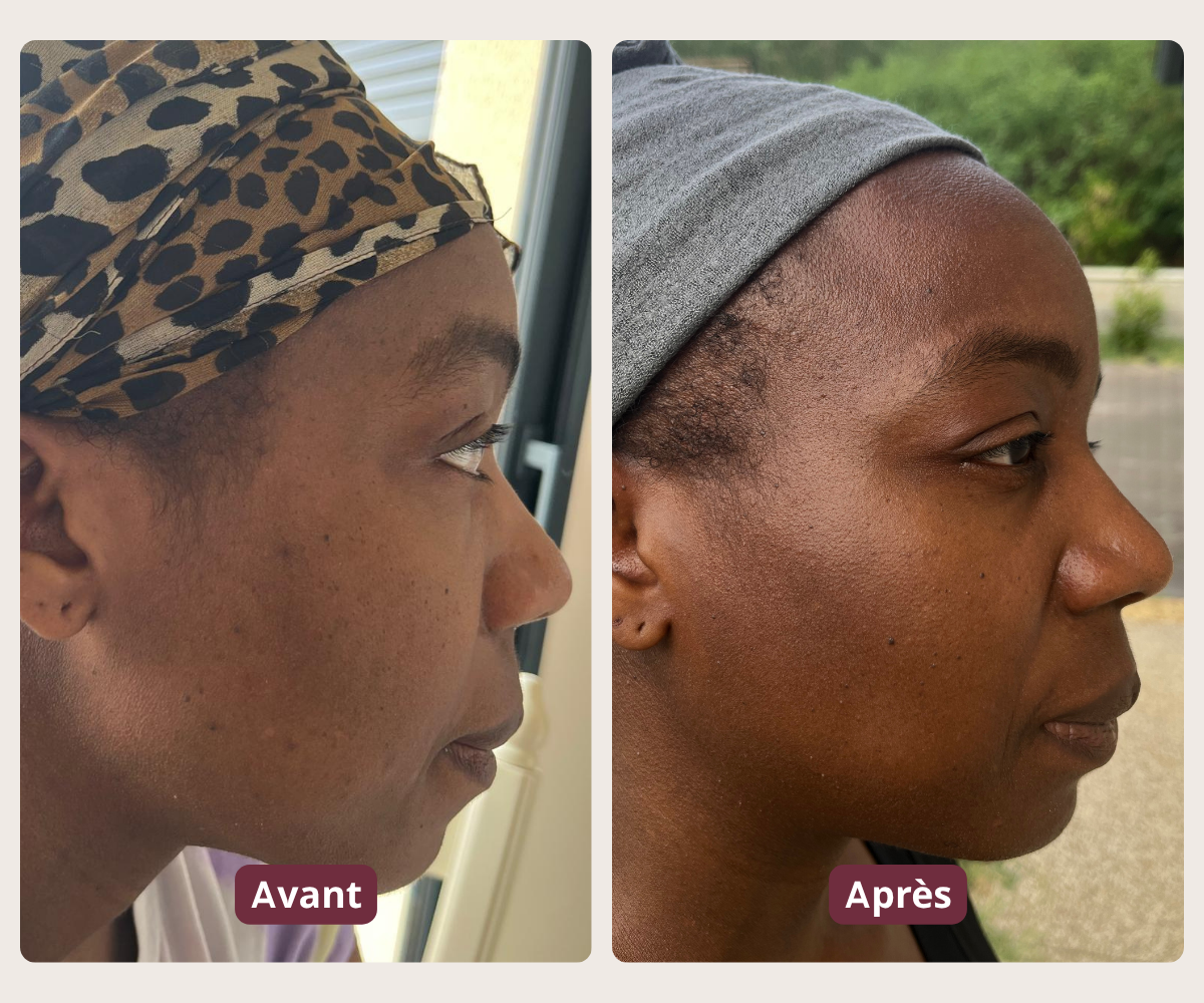 Avant-après montrant l’évolution des taches pigmentaires du visage avec la routine Mel’Uniq